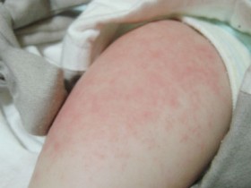 幼儿急疹图片-什么是幼儿急疹 幼儿急诊图片